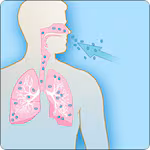 Illustration of how anthrax spores are breathed into lungs, causing inhalation anthrax