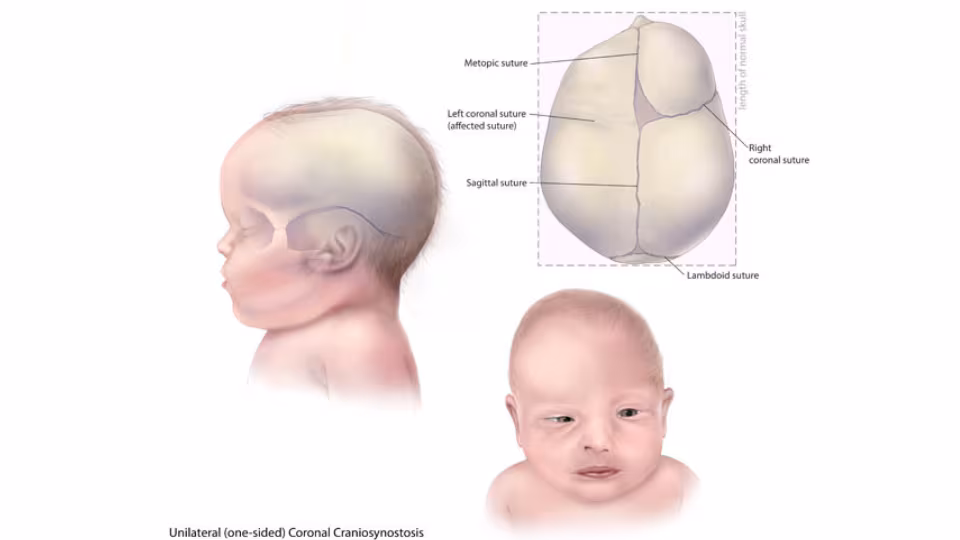 Coronal Craniosynostosis Illustration of Infant with Unilateral (one-sided) Coronal Craniosynostosis