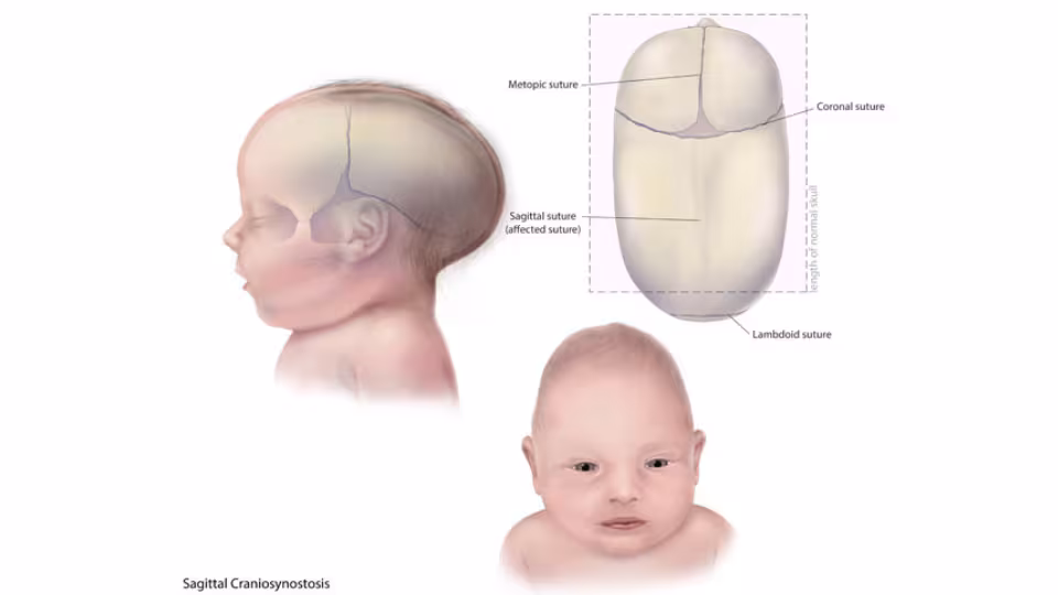 Illustration of infant with Sagittal Craniosynostosis Illustration of an infant with Sagittal Craniosynostosis.
