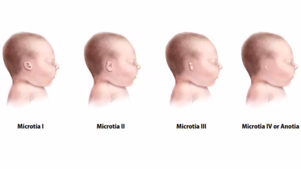 — title missing — Illustration of the range of severity for microtia/anotia, from baby with small external ear to no visible external ear.