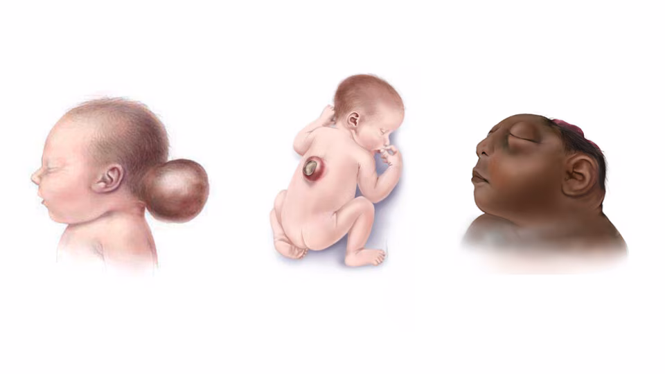 Collage of illustrations of infants with encephalocele, spina bifida, and anencephaly.