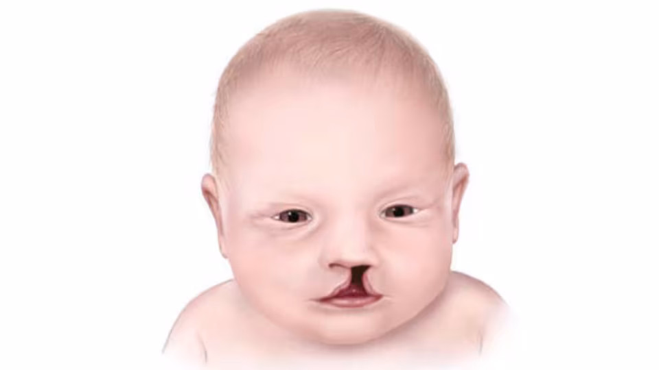 Cleft Lip Illustration of infant with a cleft lip