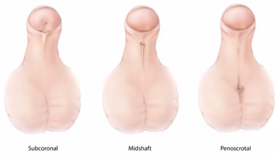 Hypospadias Medical illustration of hypospadias showing the 3 types, Subcoronal (opening of the urethra is located near the head of the penis), Midshaft (opening of the urethra is located along the shaft of the penis), Penoscrotal ( opening of the urethra is located where the penis and scrotum meet).