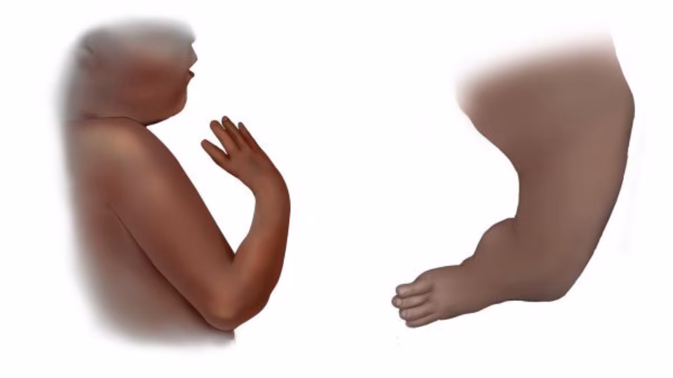 Untitleddesign13.png Illustration of infant with upper and lower reduction defects.