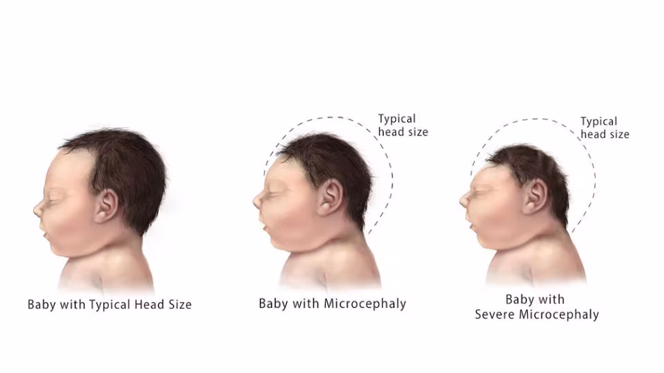 Illustration of 3 babies, one with typical head size, one with small microcephalic head, and one with extremely small head, severe microcephaly