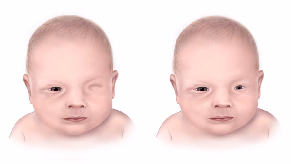 Untitleddesign9.png Illustration of two babies with anophthalmia. One baby is missing one eye and the other baby has microphthalmia, where one eye is very small.