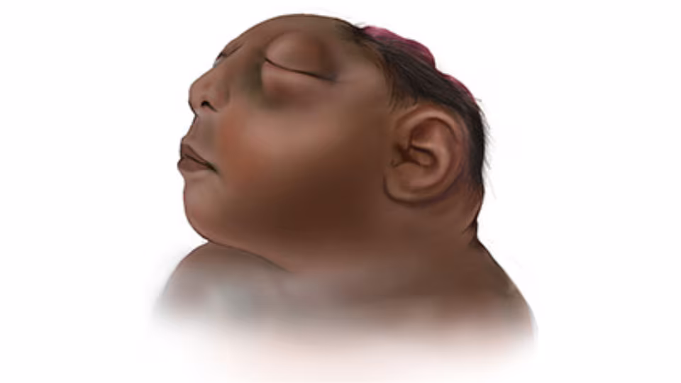 Anencephaly Illustration of infant with anencephaly, missing portions of brain and skull.