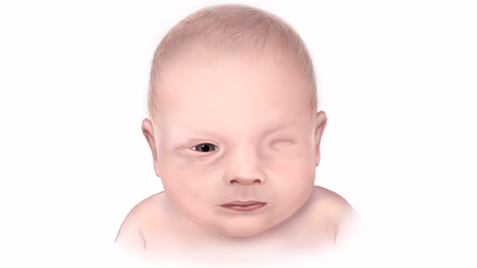 Anophthalmia Illustration of infant with anophthalmia, missing one eye.