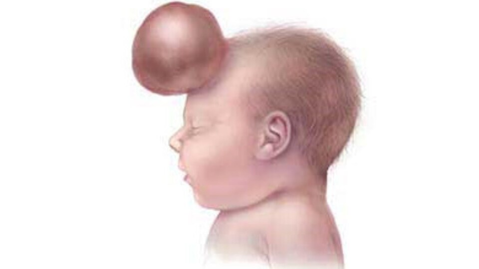 Frontal encephalocele Illustration of infant with a frontal encephalocele, protrusion on forehead.