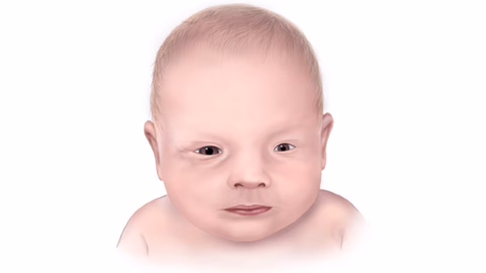 Microphthalmia Illustration of infant with microphthalmia, one small eye.