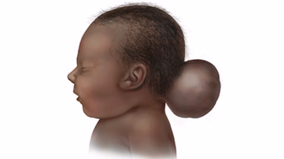 Occipital encephalocele Illustration of infant with occipital encephalocele.