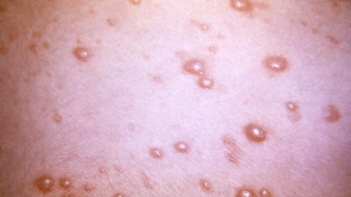 Close view of a patient’s skin surface with a pustular-vesicular rash due to the varicella-zoster virus (VZV) pathogen.