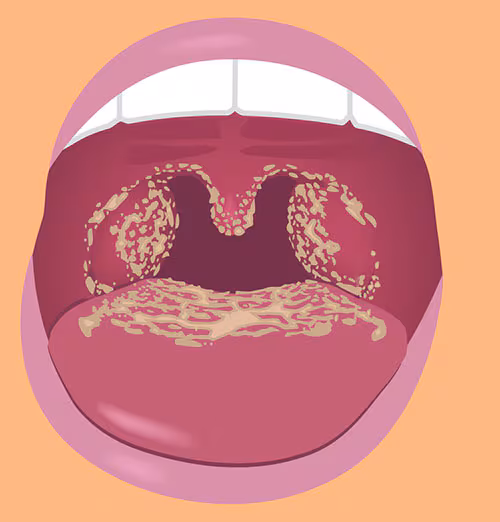 Illustration of open mouth with white patches in the back of the tongue and throat