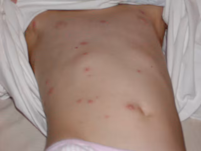 Stomach of child with light skin with breakthrough varicella. Source: Varicella Active Surveillance Project.