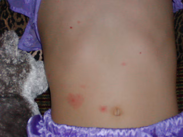 Stomach of child with light skin with breakthrough varicella. Source: Varicella Active Surveillance Project.