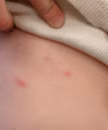 Vaccinated child with light skin with breakthrough varicella on the abdomen. Source: Varicella Active Surveillance Project.