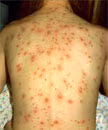 Adolescent female with varicella lesions in various stages. Source: http://www.vaccineinformation.org/photos/variaap002.jpg. Copyright: American Academy of Pediatrics