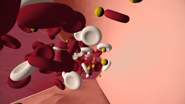 Is "bad" cholesterol building up in your arteries? Find out with a simple blood test. Talk to a health care professional about cholesterol screening.