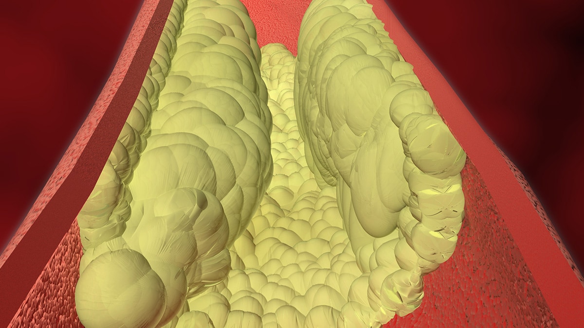 Cholesterol Facts As cholesterol (plaque) builds up in the arteries, the arteries begin to narrow