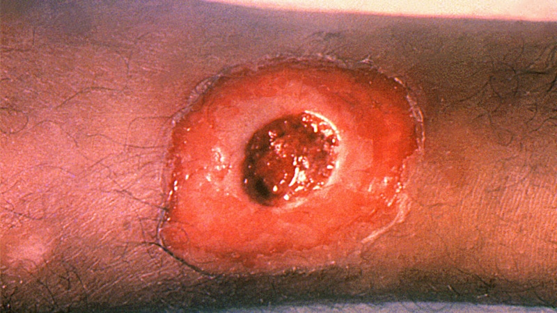 Cutaneous diphtheria A lesion on the leg caused by cutaneous diphtheria.