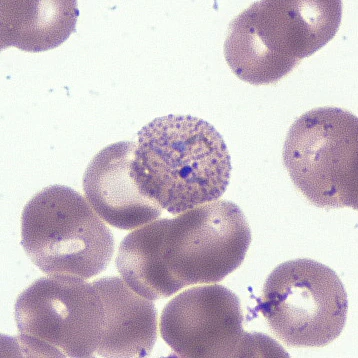 March - 2015 - Case #392