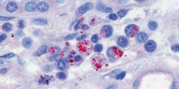 Immunohistochemical stain demonstrating E. chaffeensis morulae within monocytes in the kidney of a patient with ehrlichiosis.