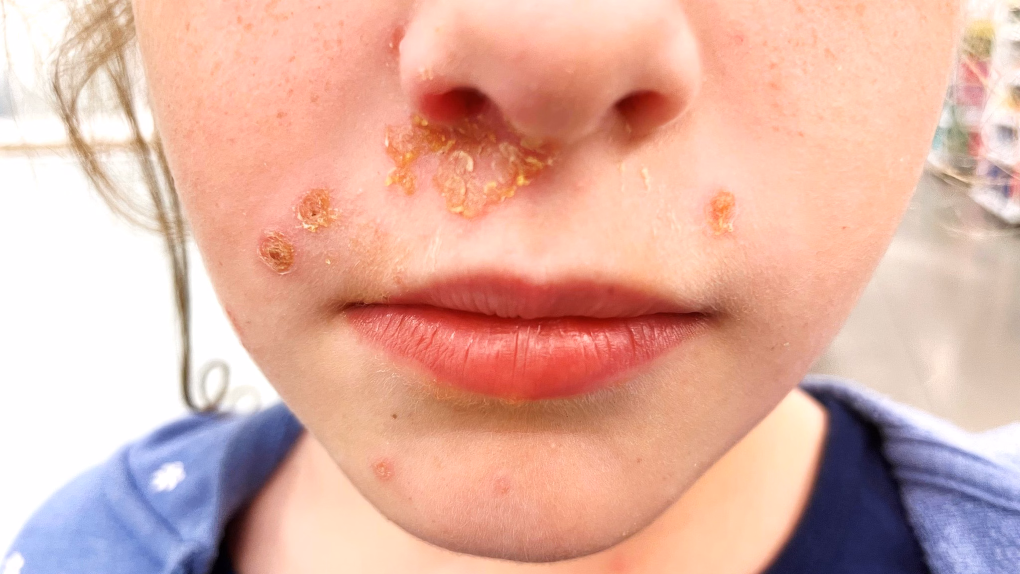 "Honey-colored' scabs on the face of a school-age child.