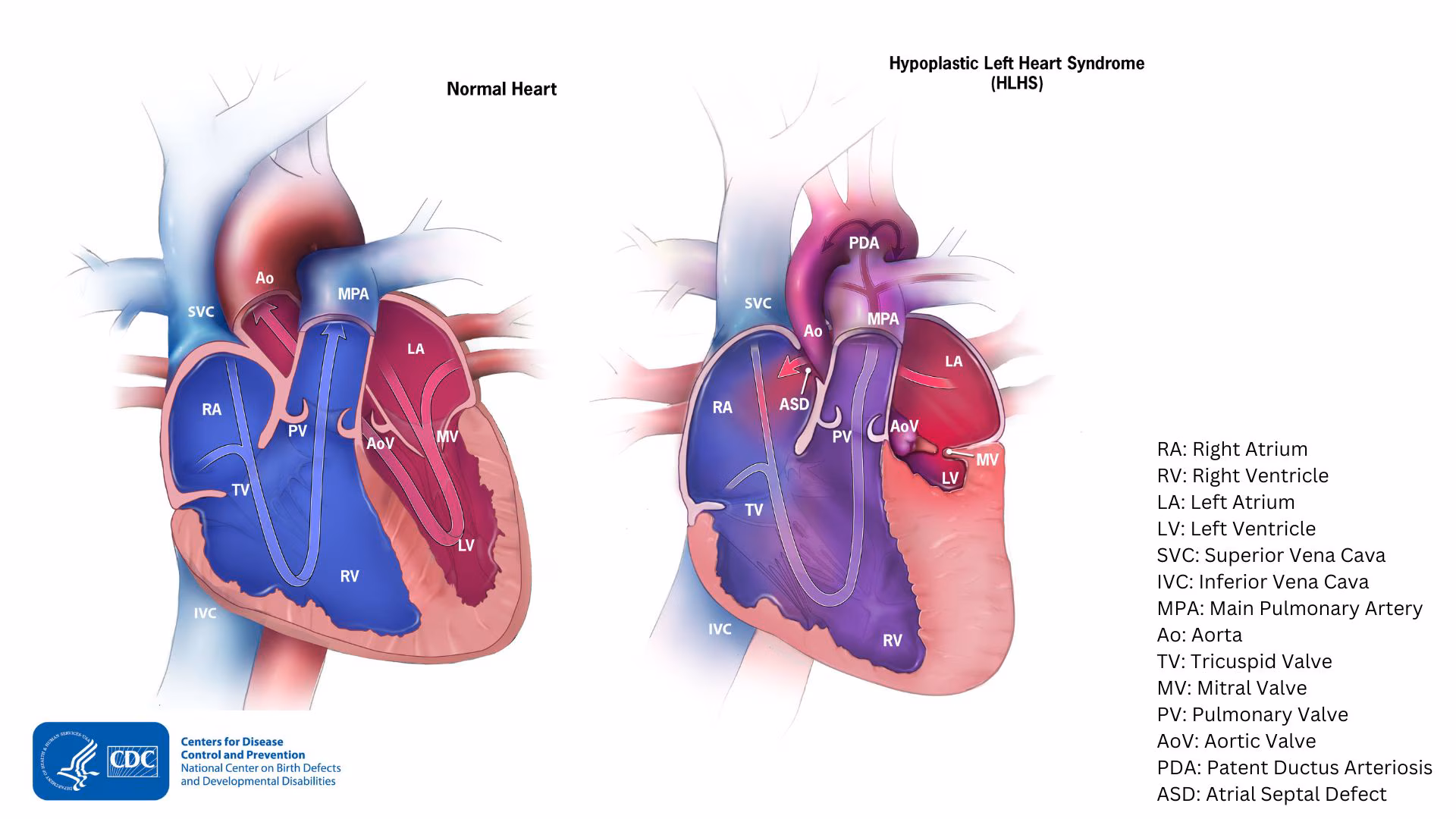 Hypoplastic left heart syndrome (HLHS) Comparison of a normal heart and a heart with HLHS