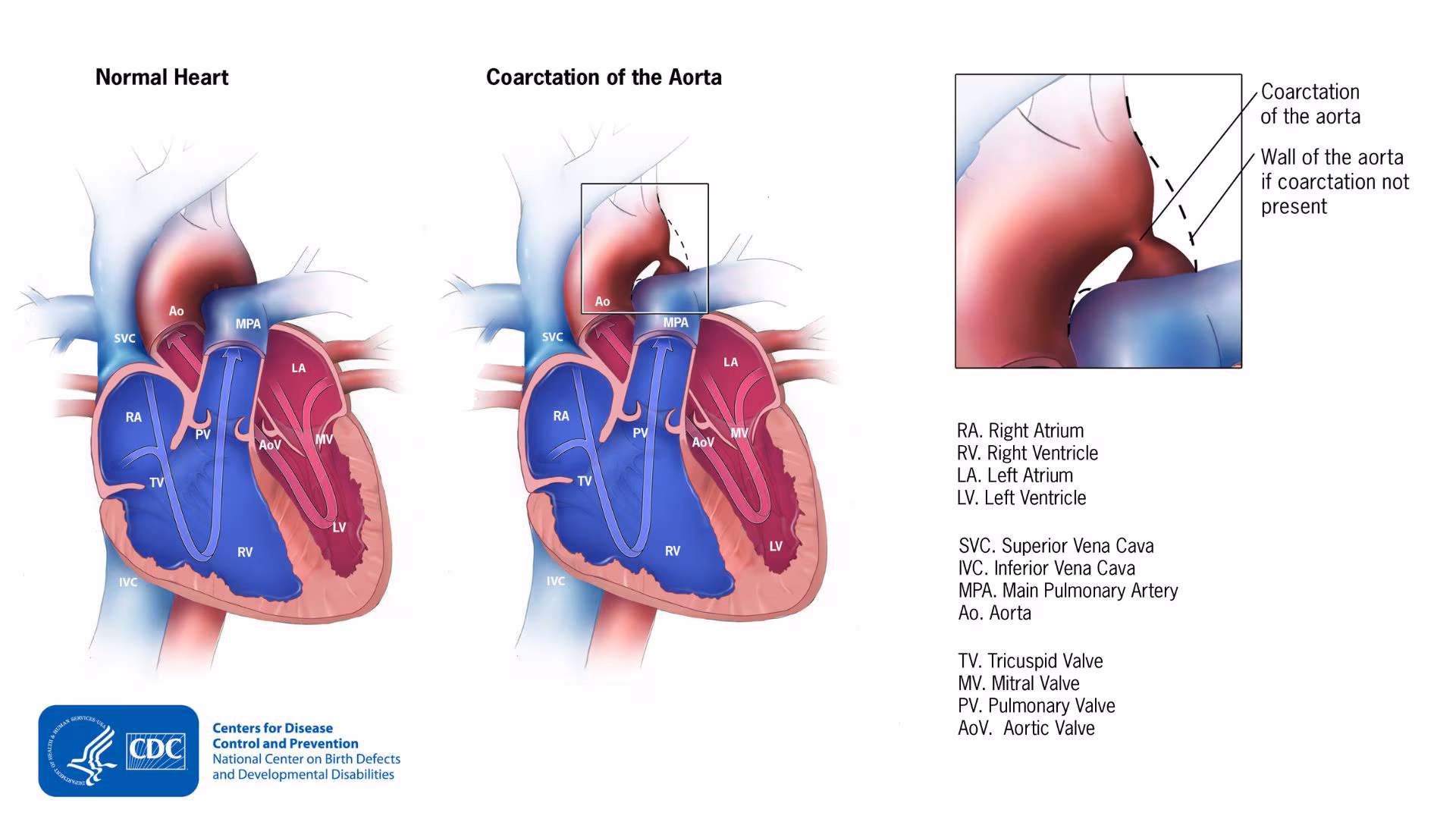 Coarctation of Aorta Normal heart to the left, heart with a coarctation of the aorta in the middle, and an enlarged view the coarctation in the upper right