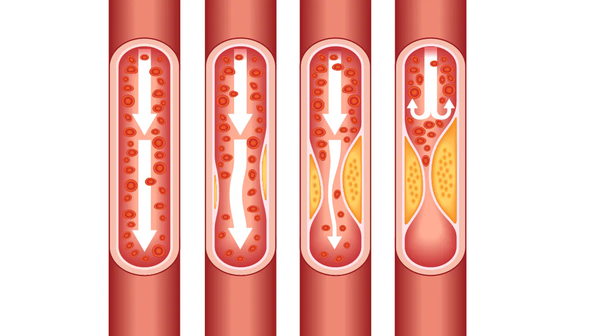 hd-facts Illustration of plaque in the arteries.