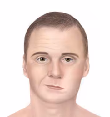 Man displaying symptoms of facial palsy
