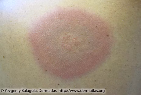 Close up image of a human's skin with a large red and blue colored rash and raised texture in the center.