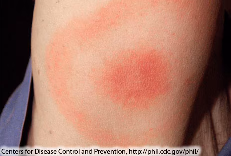 Close-up image of a circular, reddish, skin rash.