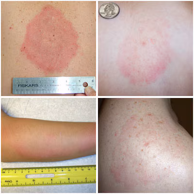 Photo of different types of rashes caused by STARI