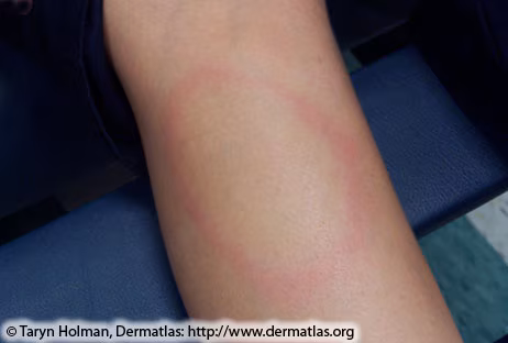 Image of a human's limb with a red circular ring flushed in the skin.