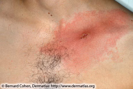 Close up image of a red rash on the skin with hair next to it.