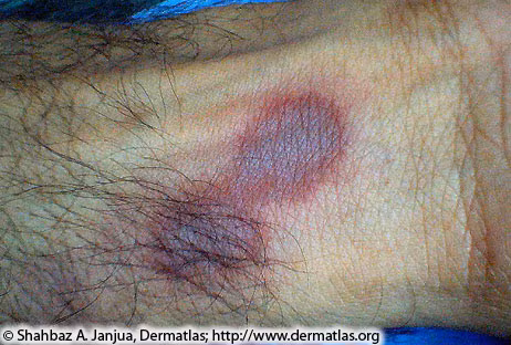 Close up image of a person's limb with a dark hyperpigmented circular shape appearing right next to a growth of hair.