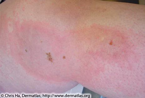 Close up image of a person's light-colored skin with a red circular-shaped flush spreading across the skin.