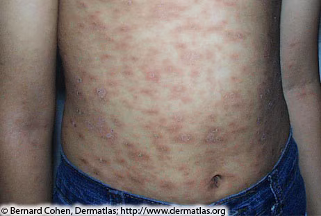 Image of a person's torso with small, raised, reddish-brownish rashes spotted throughout their entire stomach surface.