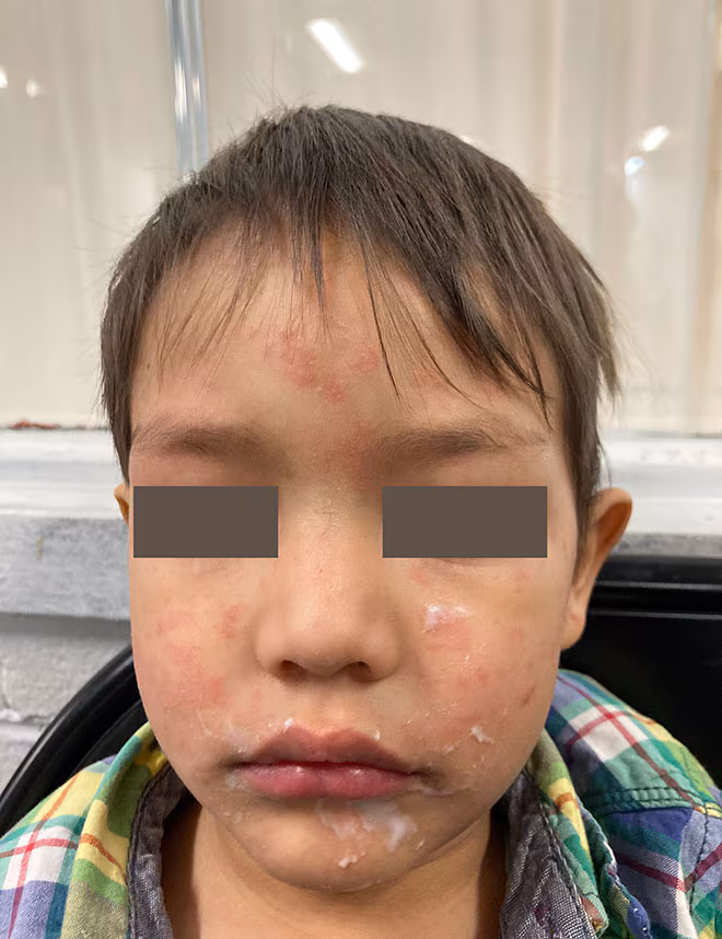 Image of measles rash on Childs face and cheeks.