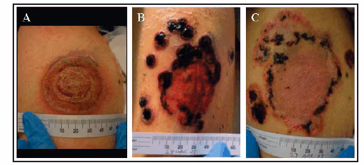 The figure shows three photographic images of a progressive vaccinia lesion in a military smallpox vaccinee. The photos were taken on March 5, March 27, and April 27, 2009, respectively.