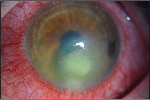 The figure above is a photo that shows findings characteristic of a contact lens–related corneal infection.