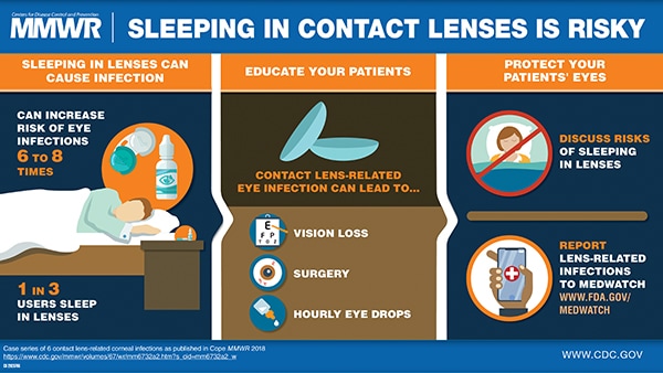 mm6732a2_Corneal_Infections_Contact_Lenses_600x338 The figure above is a visual abstract that discusses the risk for sleeping in contacts.