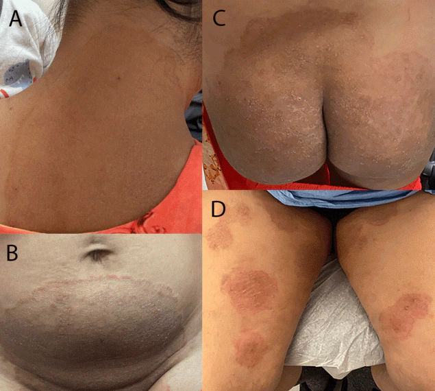 Notes from the Field: First Reported U.S. Cases of Tinea Caused by Trichophyton indotineae — New York City, December 2021–March 2023 The figure includes four photographs of lesions occurring on the neck, abdomen, and thigh areas of two patients in New York City, caused by the first reported U.S. cases of tinea due to Trichophyton indotineae infection during December 2021–March 2023.