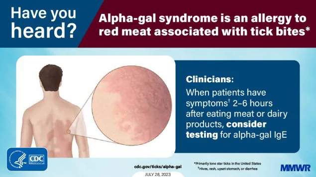 Health Care Provider Knowledge Regarding Alpha-gal Syndrome — United States, March–May 2022 The figure is a graphic with an illustration of a rash on a person’s back with text about alpha-gal syndrome.