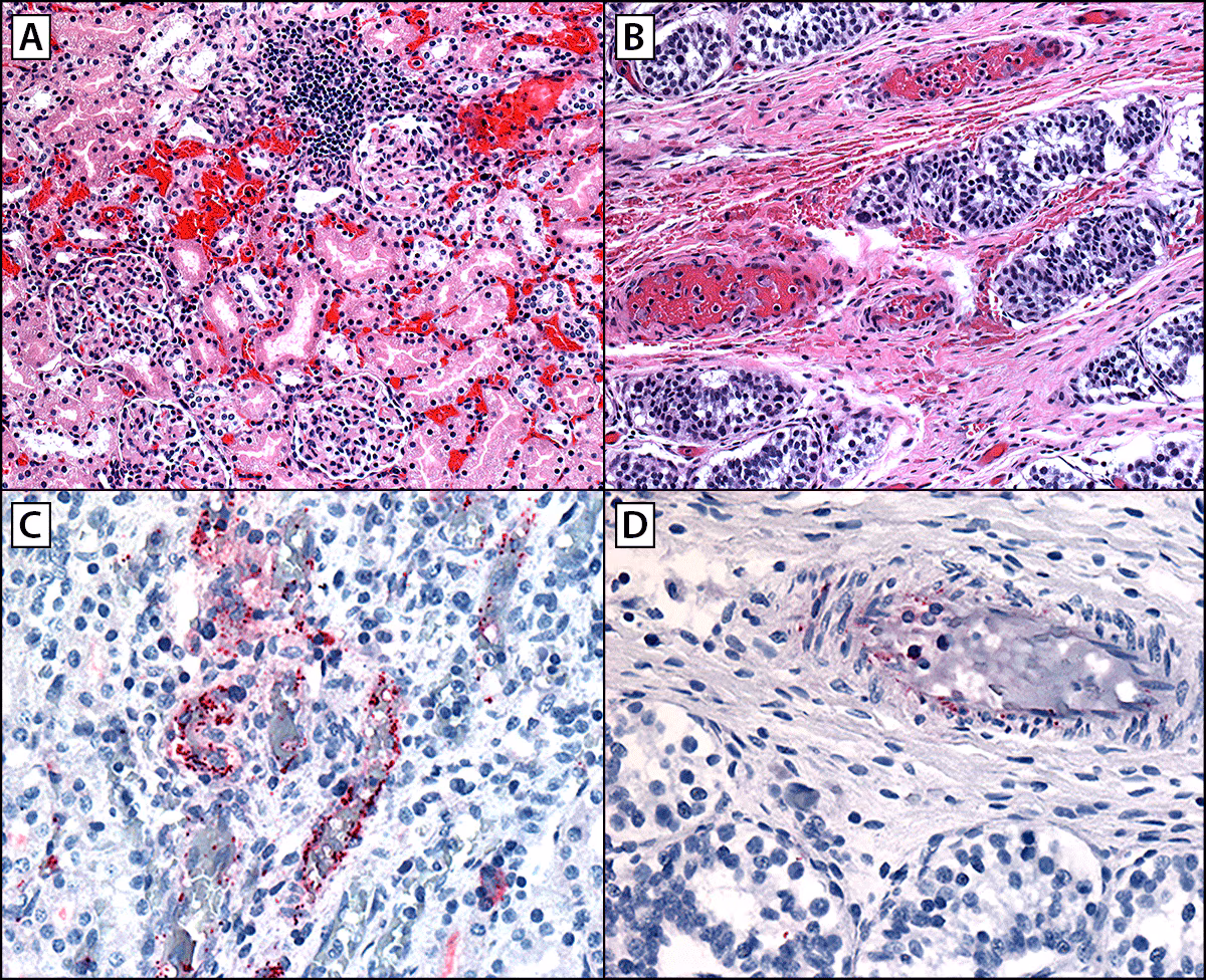 Severe and Fatal Rocky Mountain Spotted Fever After Exposure in Tecate, Mexico — California, July 2023–January 2024 Figure is a series of four images illustrating the histopathologic findings in a fatal pediatric case of Rocky Mountain spotted fever showing extensive microhemorrhages, vascular inflammation, and endothelial injury in multiple organs including kidneys (A), testes (B), and rickettsial antigens identified by immunohistochemistry distributed predominately in endothelial cells of capillaries, arterioles, and venules in the vasa recta in the kidneys (C), and in interstitial areas in testes (D) in California in August 2023.