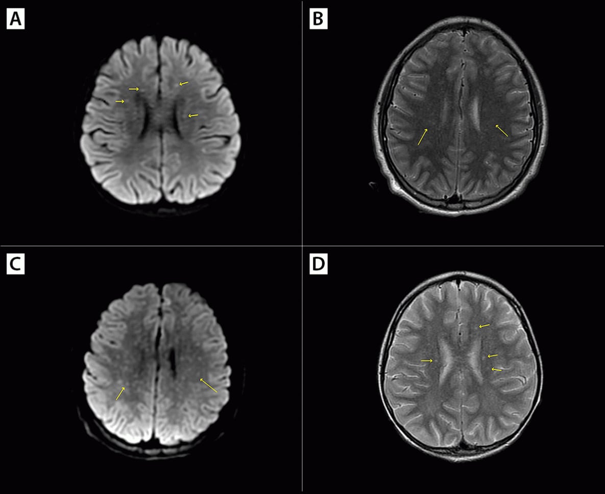 Severe and Fatal Rocky Mountain Spotted Fever After Exposure in Tecate, Mexico — California, July 2023–January 2024