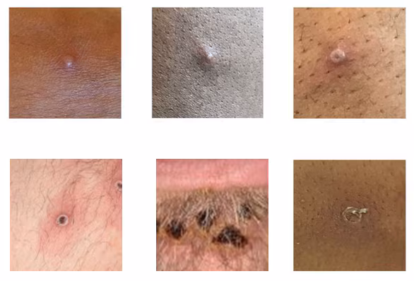 Mpox rash examples Six photos of mpox lesions on different skin tones and types.