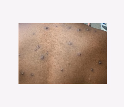 Mpox rash 7 Photo of multiple dark bumps on a dark-skinned person's back