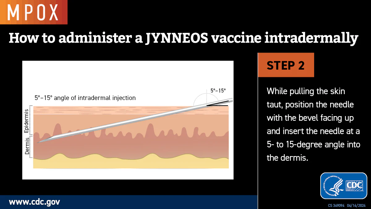 Intradermal Injection Step 2b Graphic showing the correct angle to insert a needle for mpox intradermal vaccination.